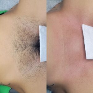 Brazilian waxing before and after